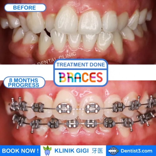 Braces . Pendakap Gigi . Ortho 绑牙