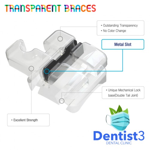 Transparent Braces . lutsinar Pendakap Gigi . Ortho 绑牙