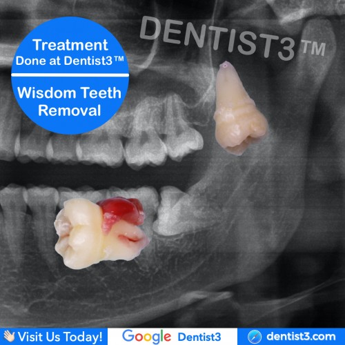 Wisdom Tooth Removal . Cabutan Gigi Geraham Bongsu Malaysia . 拔智慧齿